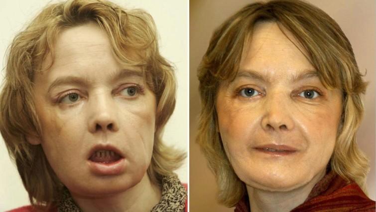 Primeiro transplante parcial de face é realizado na França